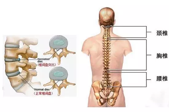 腰椎间盘突出打球戴护腰好吗(“腰椎间盘突出症”拍了拍你)