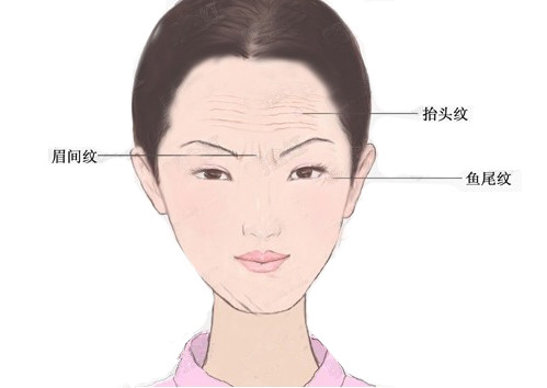 川字纹让你显老10岁 用这3种方式治疗才有效