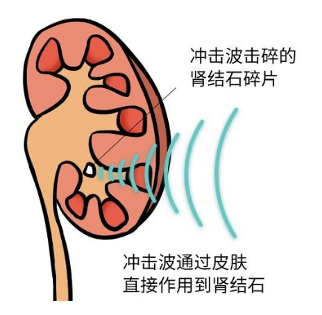 泌尿系统结石，解说体外冲击波碎石术的适应症和禁忌症