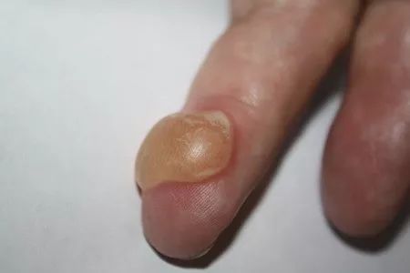 偏方害人：面粉、牙膏、酱油、醋…不治烧烫伤，别再继续被骗了