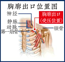 锁骨太过饱满，摸起来还很硬？很可能是你这长了肿瘤