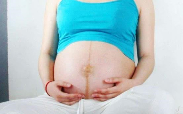 怀孕后肚皮上长“黑线”？准妈妈别苦恼，做好4件事有利于恢复