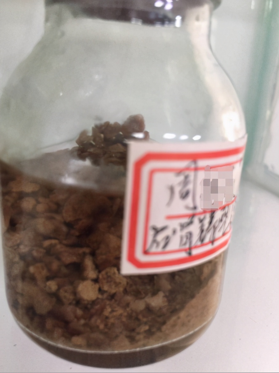 突发腰痛别小视！湖北大叔突感腰痛经查结石严重致肾功能受损