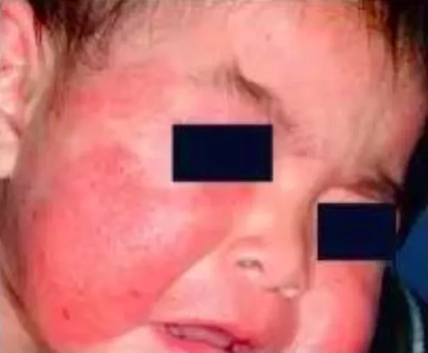 治疗宝宝濕疹哪有那么难？就这3招，用对方法最重要！