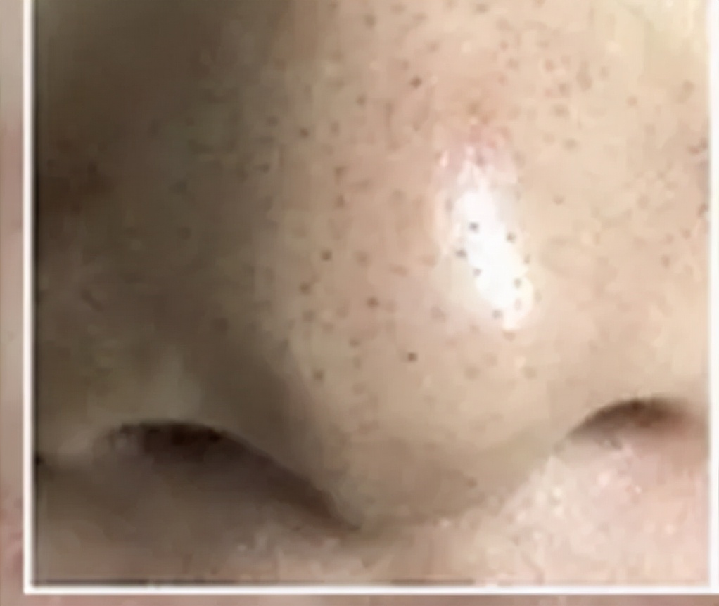 你鼻子上的真的是黑头吗？教你正确祛黑头