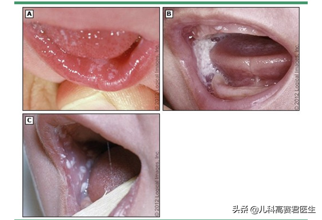 宝宝鹅口疮怎么办？儿科医生告诉你