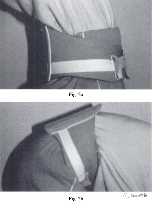 从诊断到治疗：全面解析腰椎峡部裂(lumbar spondylolysis)