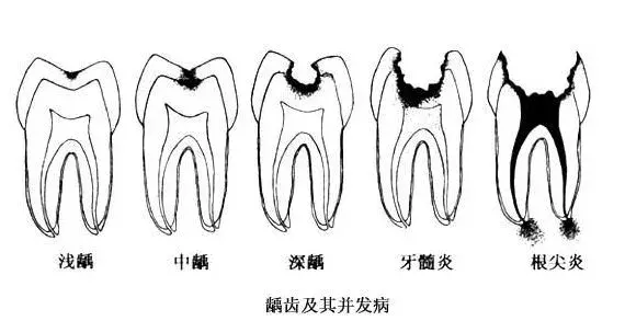 几十块钱就能补好的牙，久拖不治，以至要花上万，冤不冤？