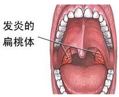 一白遮百丑，口臭毁所有！口臭问题该如何解决？