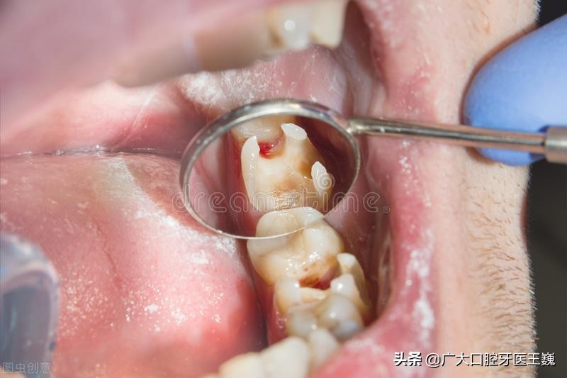 良心牙医：不建议根管治疗