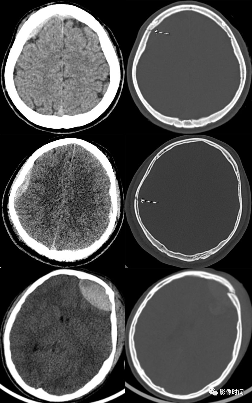 颅脑外伤的急诊 CT 表现