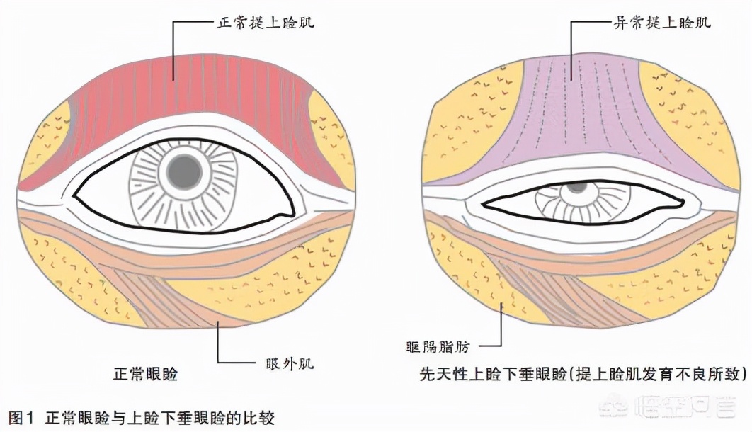 做上睑下垂矫正手术是一种什么体验呢？