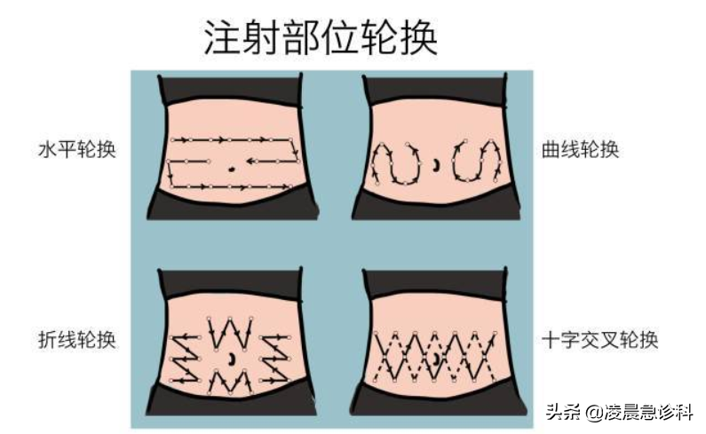 胰岛素只会打肚子？肚子全是针眼没好地，手把手教你如何打胰岛素