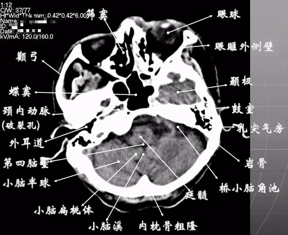 简明又详细的头部CT读片详解，收藏