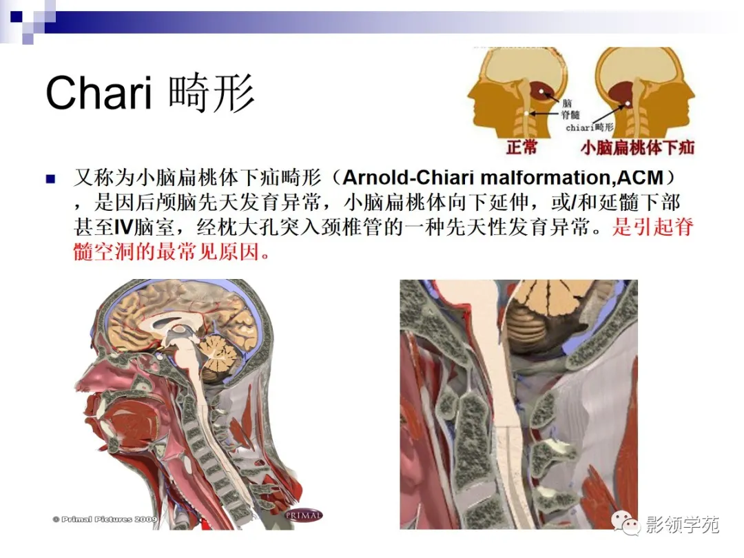 小脑扁桃体下疝畸形概述