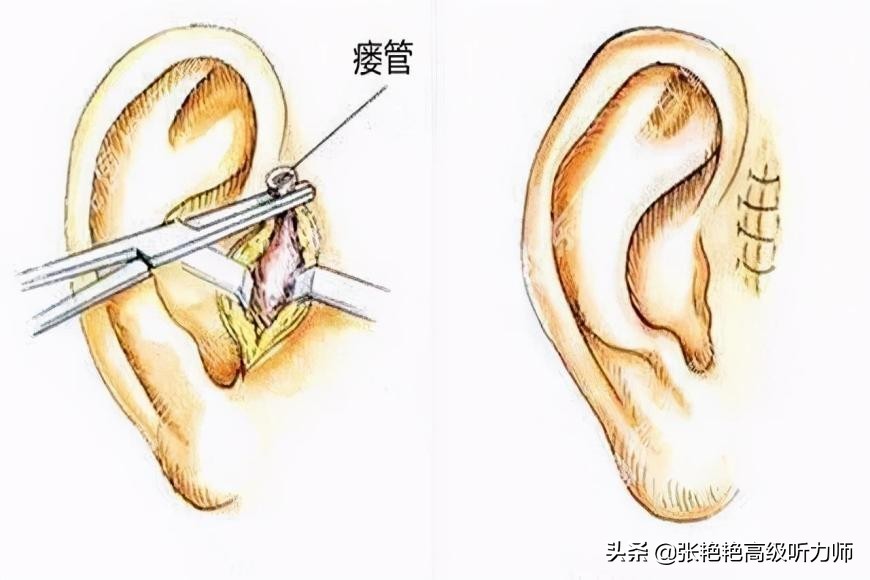 耳仓手术图解图片