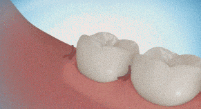 十种智齿不能拔的图片(拔掉智齿，有助改善味觉功能！这6种智齿别再留着了)
