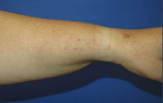 这种前臂背外侧的瘙痒以及疹子常诊断为皮炎湿疹，其实诊断错了