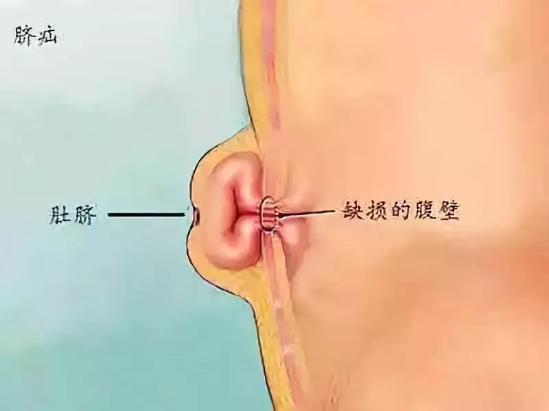 宝宝肚脐眼居然鼓出一个包？到底什么时候会好，需要手术吗？