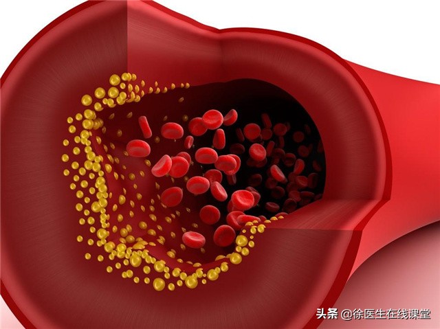 看不懂血脂检查单？这4项指标最重要！有一个超标，就要留心