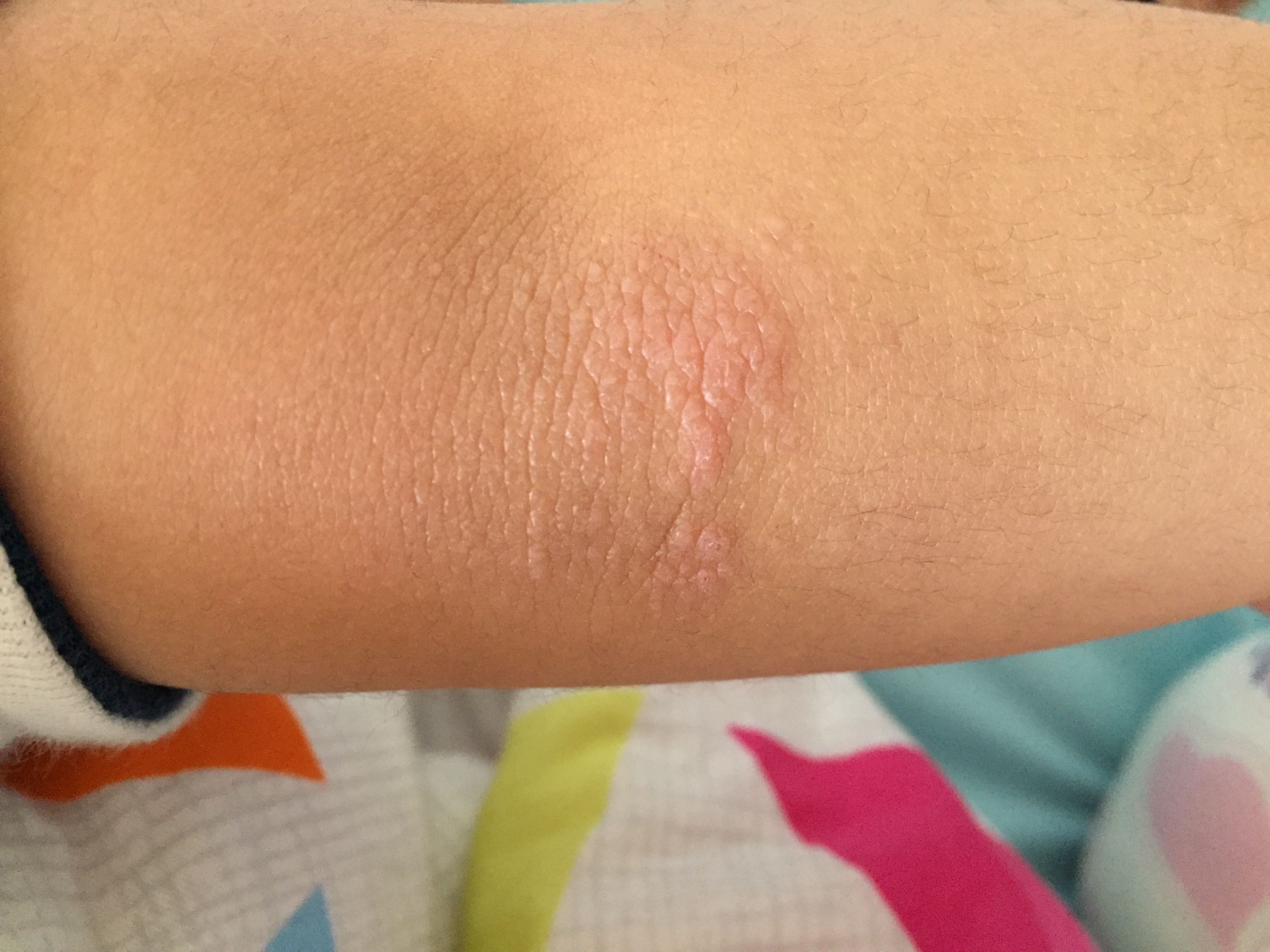 夏天到来,小朋友的皮肤出现小丘疹,这是什么病?