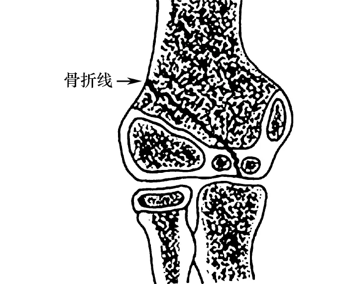 急诊来了骨折的小淘气，如何综合制定诊疗方案？