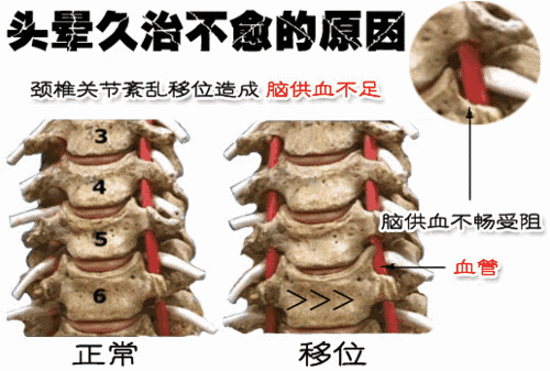 中老年人椎动脉型颈椎病,是椎动脉遭受刺激或压迫,以致椎-基底动脉