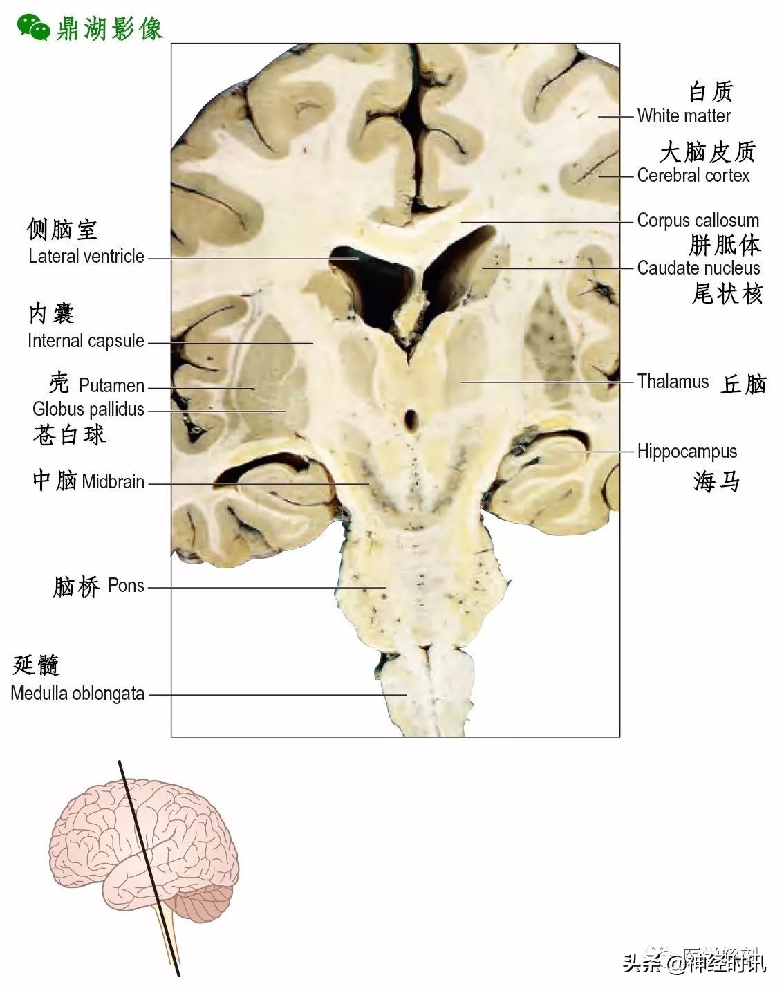 脑基底节区解剖图图片