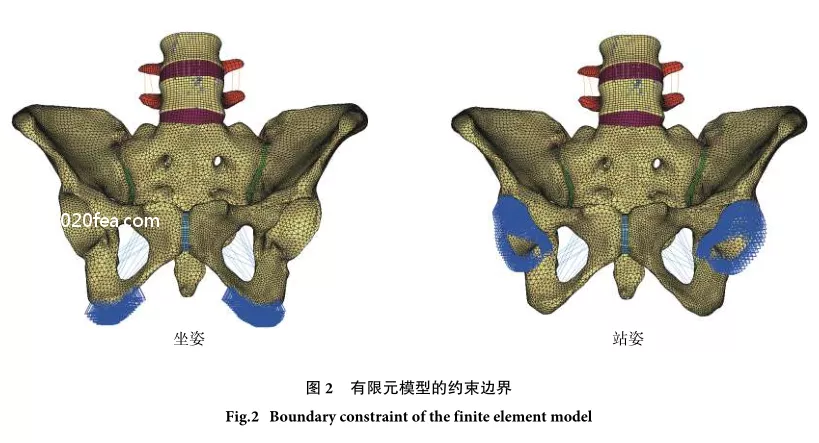 U型骶骨骨折固定的有限元分析