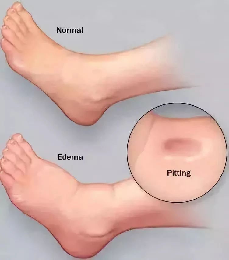 肾不好的人，为什么会水肿呢？怎么消肿？