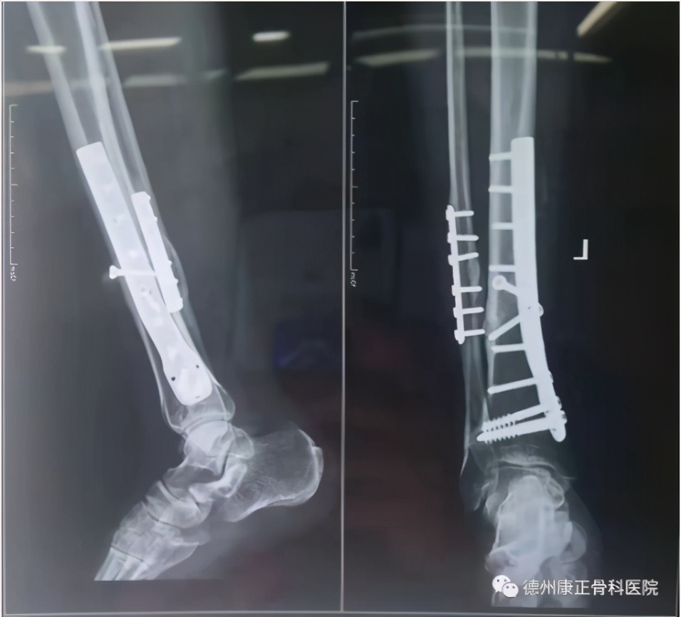 十八般“武器”齐上阵，卸掉体内13年“枷锁”