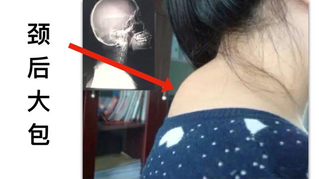脖子后面为什么会有"富贵包"?有什么办法能消除?