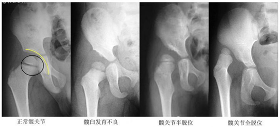 辟谣！肠胀气排气操随便做？当心宝宝髋关节有问题