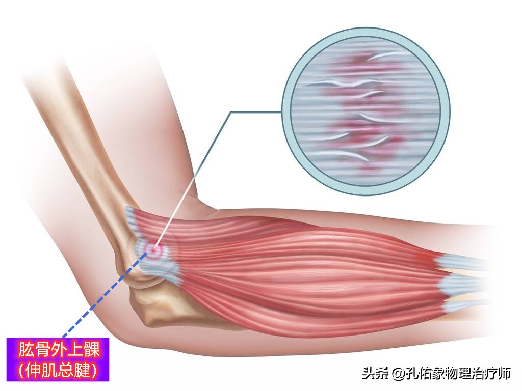 打羽毛球打到肘部痛什么原因(网球肘是累出来的，跟打网球没啥关系，如何预防及治疗？真相来了)