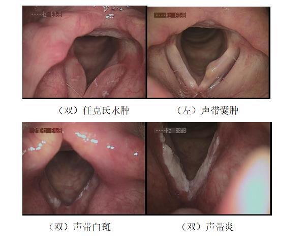 耳鼻喉医话丨我声音嘶哑了，喉镜检查必须做吗？