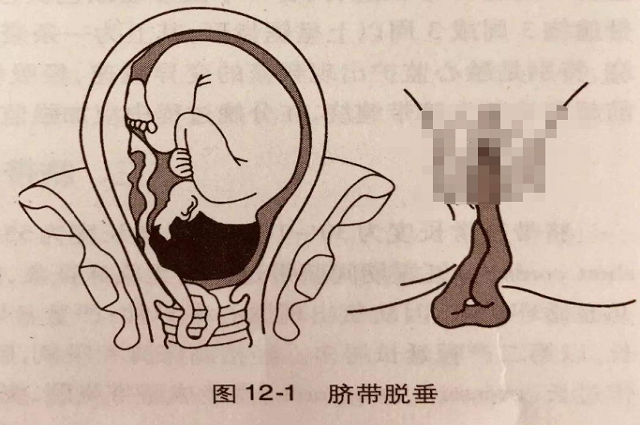为什么医生有时会劝孕妈剖宫产？是为多赚钱吗？真实原因令人唏嘘