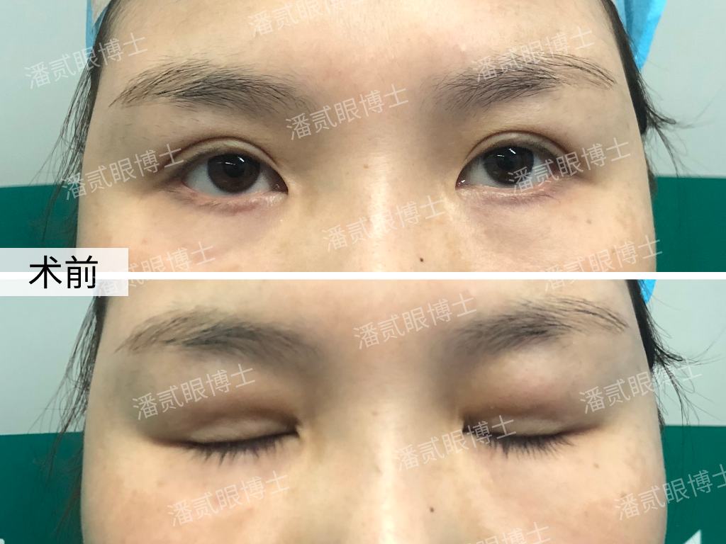 多年前做韩式三点双眼皮,术后显假还有肉条感,年少无知太悔恨了