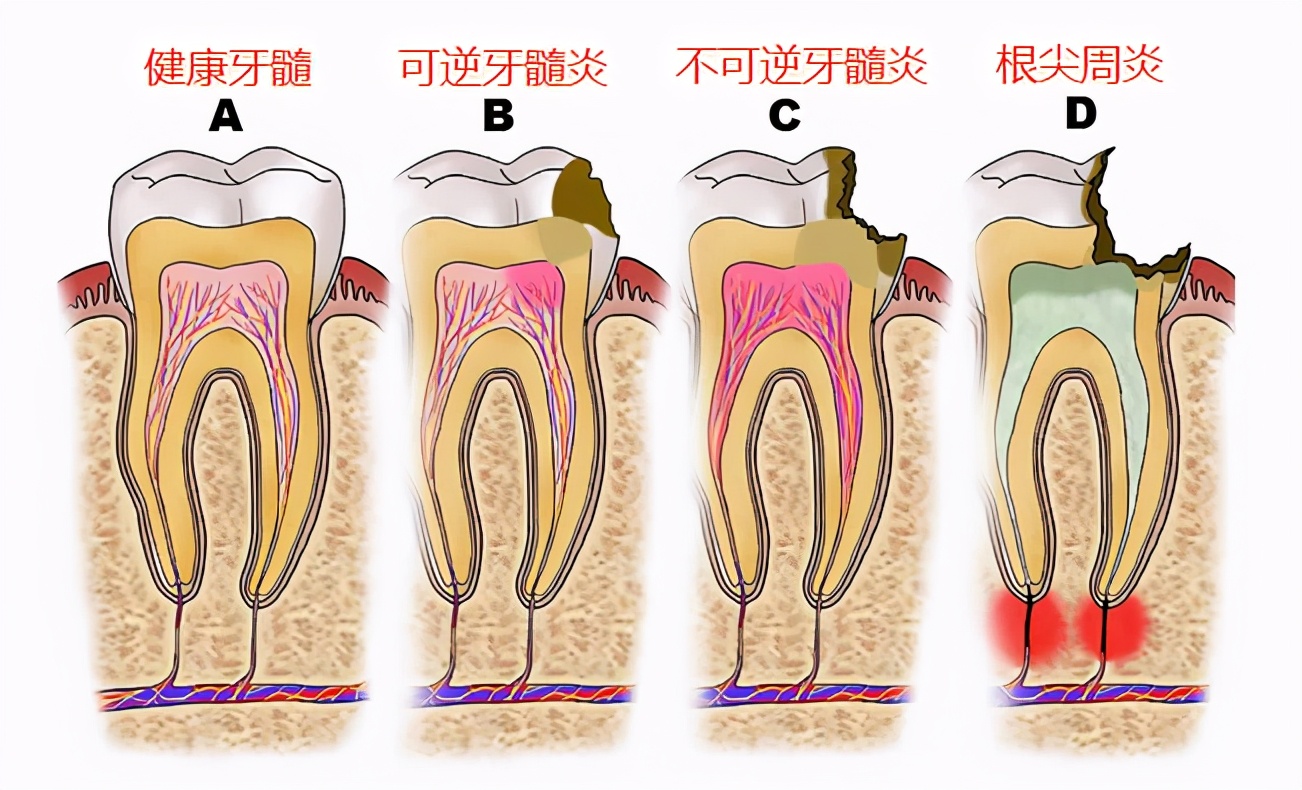 宝宝蛀牙不疼更可怕！后面可能有“敲骨吸髓”手术等着它