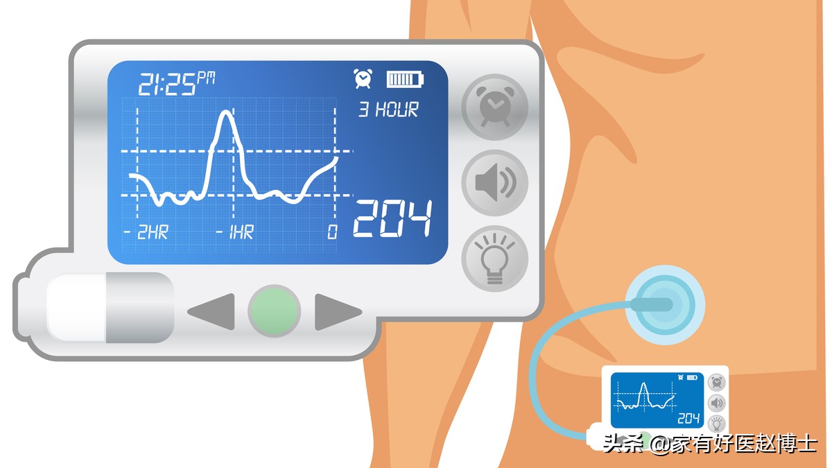 有“人工胰腺”之称的胰岛素泵，有何优势又适合哪些糖尿病患者？