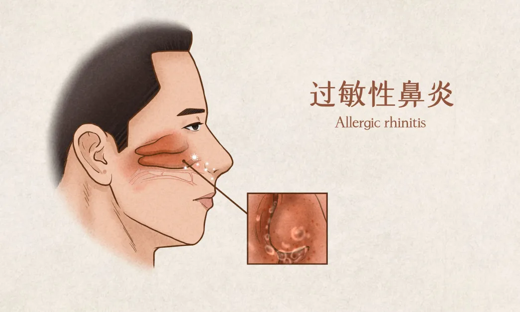 过敏性鼻炎不用怕,科学用药是关键