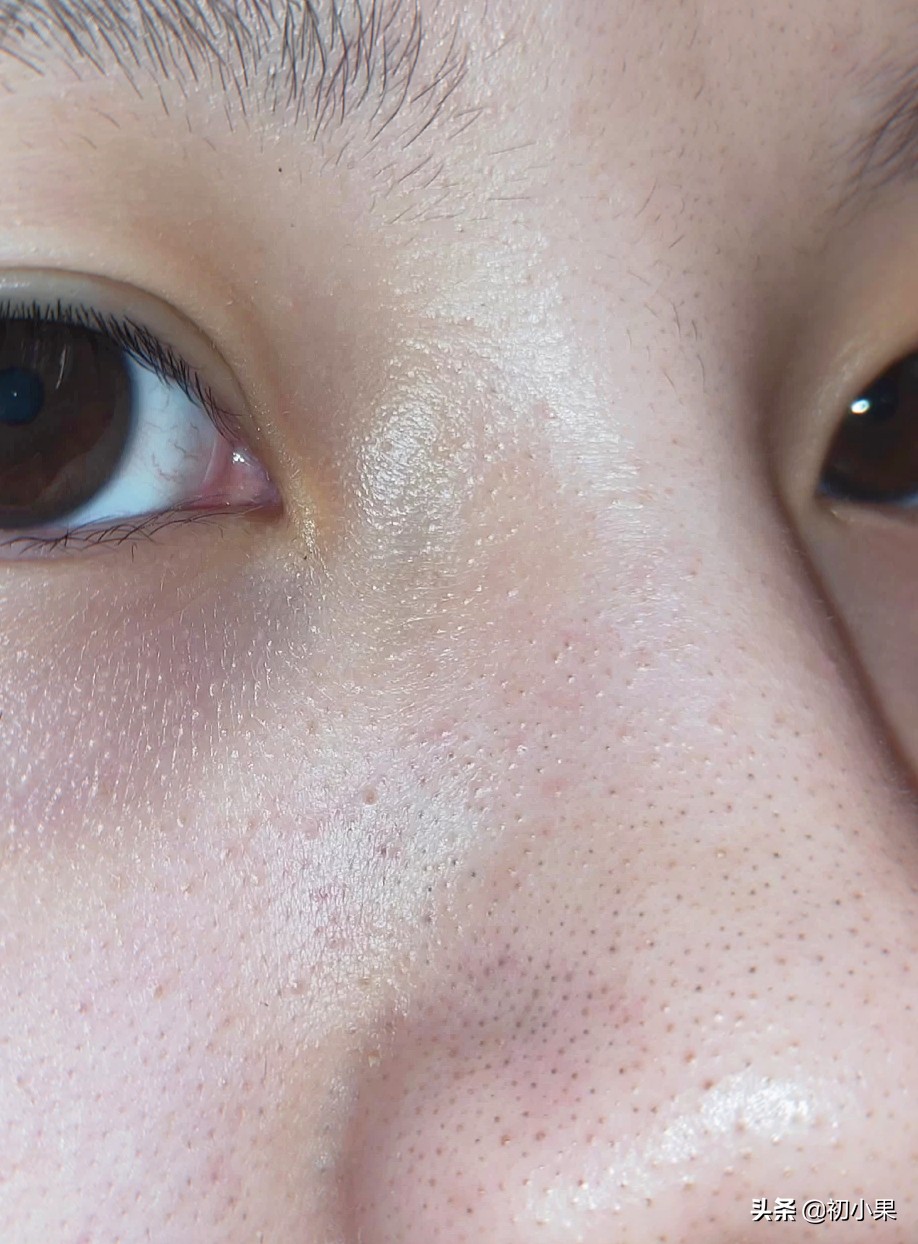 如何正确洗鼻并有效去除鼻子上的黑头