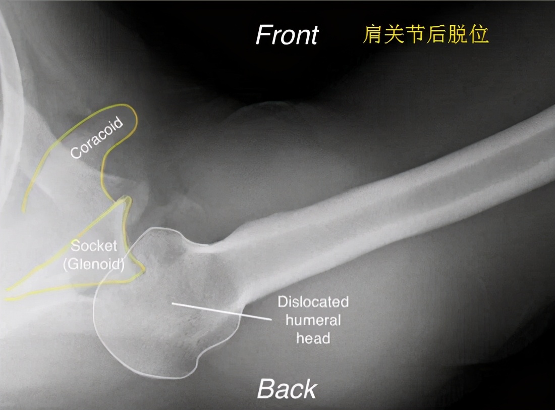 rom康复训练是什么意思(肩关节后方稳定术后康复方案)