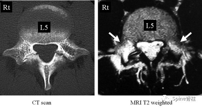 从诊断到治疗：全面解析腰椎峡部裂(lumbar spondylolysis)