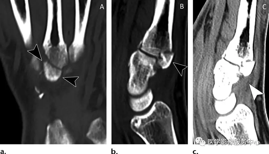 21种手腕部撕脱骨折及损伤