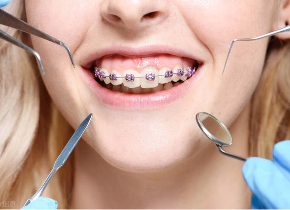 但是牙齿矫正有黄金期,在这个年龄阶段做矫正治疗是效果最好的