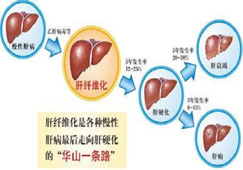 肝炎、肝硬化、肝腹水，三种肝病的检查和治疗，都是干货