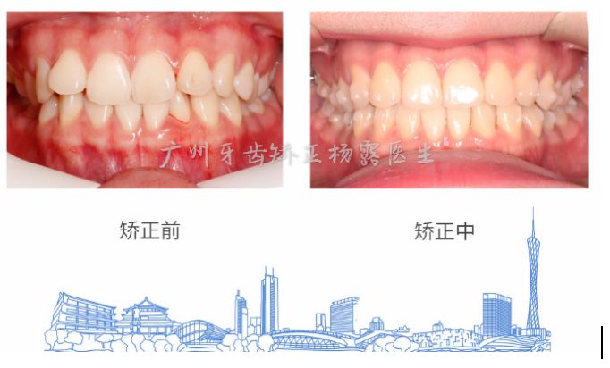 广州牙齿矫正杨露隐适美隐形矫正戴牙套全案例