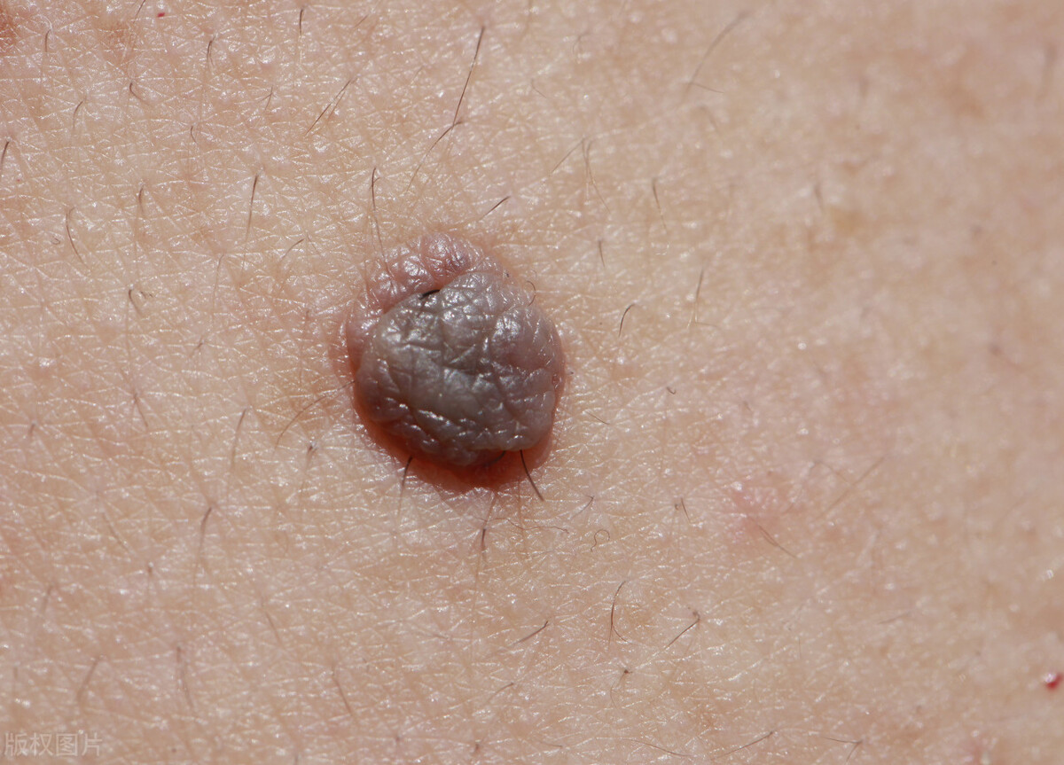 人乳头瘤病毒感染是什么症状,人乳头瘤病毒感染严重吗-友友