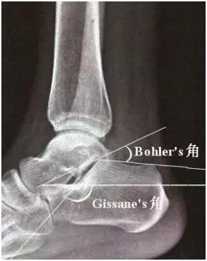 摔跤后脚后跟疼痛，警惕跟骨骨折，必要锻炼预防后遗症