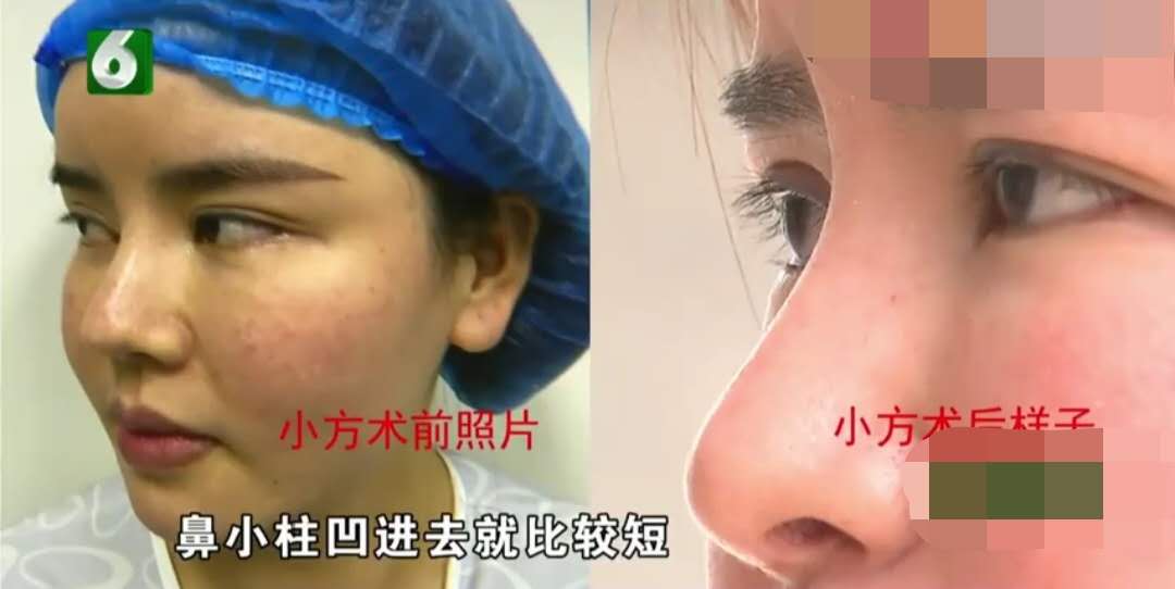 社会民生丨女子花4万5做鼻子微整，做完后很烦：我不是来毁容的